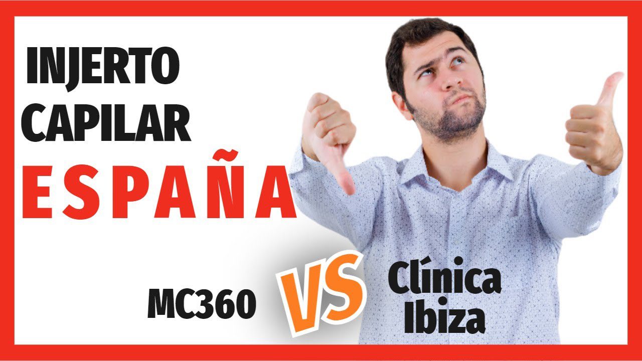 injerto-capilar-clinica-ibiza-madrid-opiniones - Baleares Noticias 24h injerto capilar clínica ibiza madrid opiniones